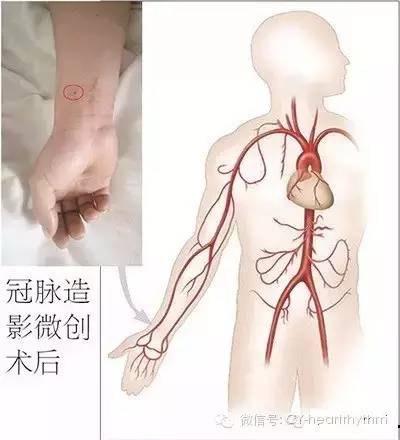 哪些人需要做冠脉造影动画,什么人需做心脏冠脉造影