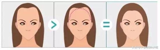 m发际线怎么修剪,有什么办法补救m型发际线