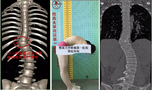 儿童先天性腰骶部脊柱侧弯,孩子弯腰驼背站不直警惕脊柱侧弯