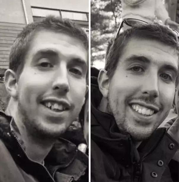 后悔整牙和不后悔整牙,整牙一般整到什么样就可以了