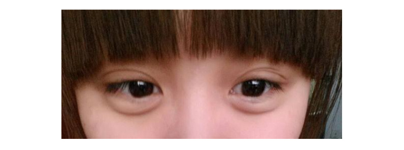 女大学生泪沟黑眼圈用什么眼霜,眼霜能去脂肪粒吗