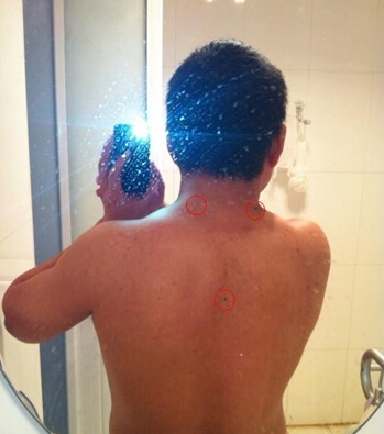 男人背部痣的分析图,男后背有痣的各个部位详细图