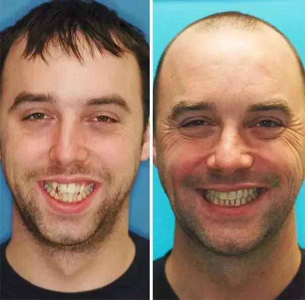 后悔整牙和不后悔整牙,整牙一般整到什么样就可以了