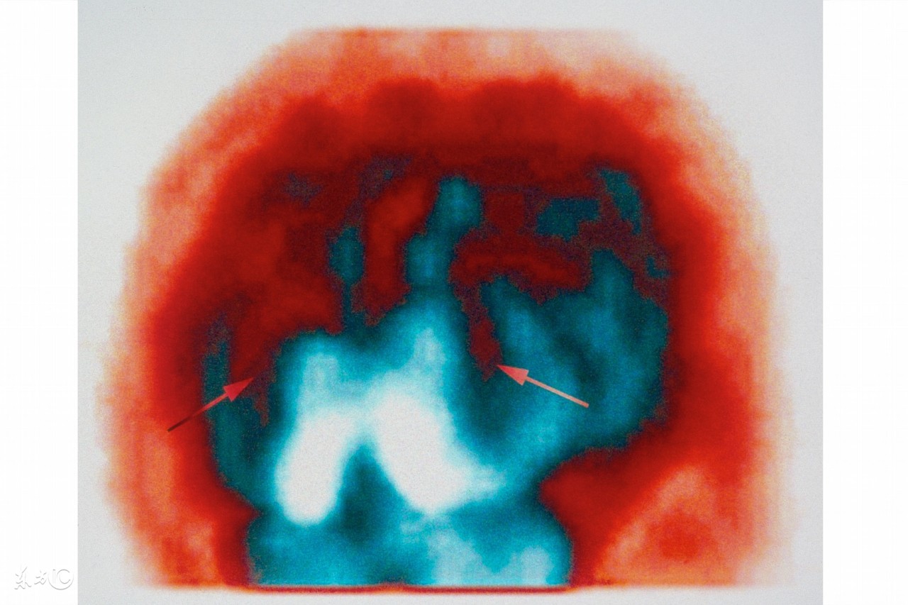 护理新生儿缺血缺氧性脑病的方法有哪些