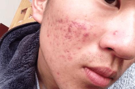 一张脸别被痘印毁了，怎么预防痘印，痘印怎么消除