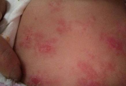 婴儿脸上疹子,婴儿疹子