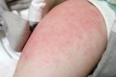 婴儿脸上疹子,婴儿疹子