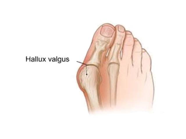 找到原因改变原因,脚磨的泡是怎么形成的