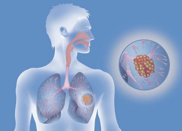 慢性支气管炎患者这几件事要避免,中医能彻底治愈慢性支气管炎吗
