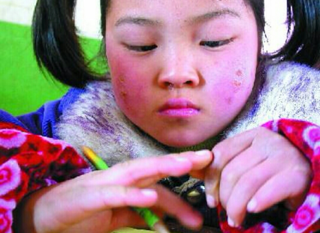 冻伤疮什么意思,手冻伤起疮最有效的方法