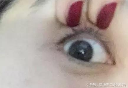 碧*诺斯**兰要你更美：用手抠掉痂皮，没色你怪谁？