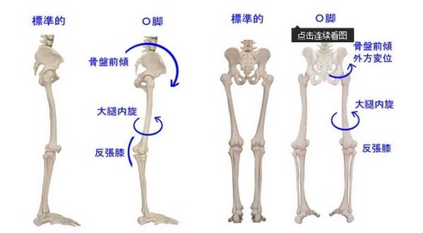 x型腿该如何改善o型腿,o型腿矫正纯干货分享