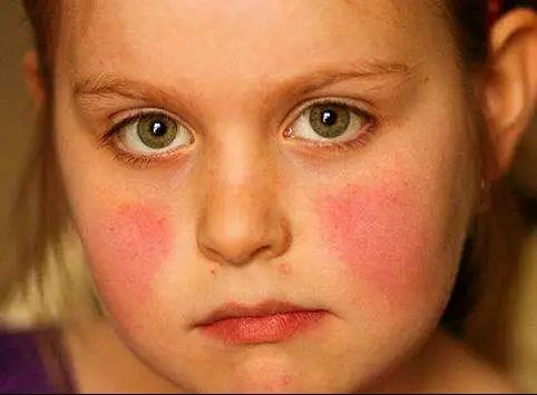 特禀质过敏体质,特禀体质是什么症状