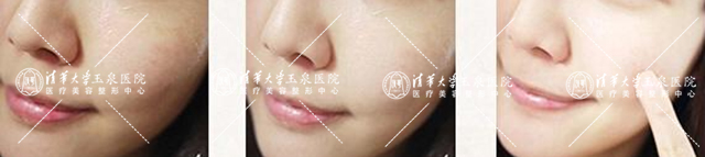 光子嫩肤祛斑后怎么看效果,光子嫩肤去黑点