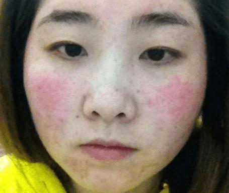 激素脸依赖性皮炎怎么根治,激素脸依赖性皮炎怎么修复