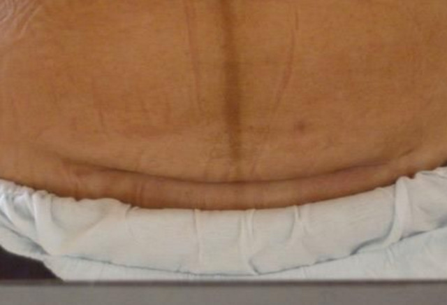 女人剖腹产两年疤痕痒痒,剖腹产20天后刀口疤痕发红发痒