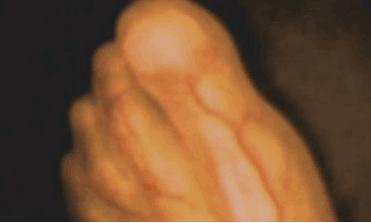 怀孕35周孕妇大哭危害,孕妇怀孕33周差点被下病危通知书