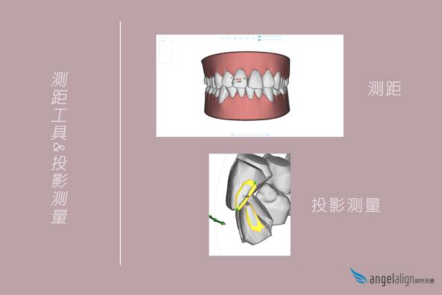 隐形矫正真的那么好吗？赵美牙带你破解隐形矫正五大谣言
