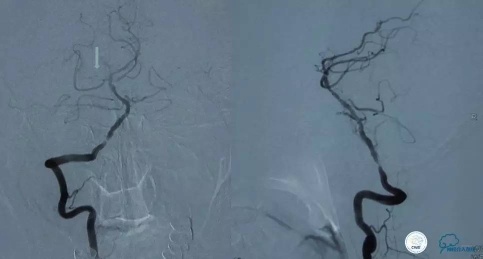 急性缺血性卒中静脉溶栓2018指南,急性缺血性卒中血管内再通标准