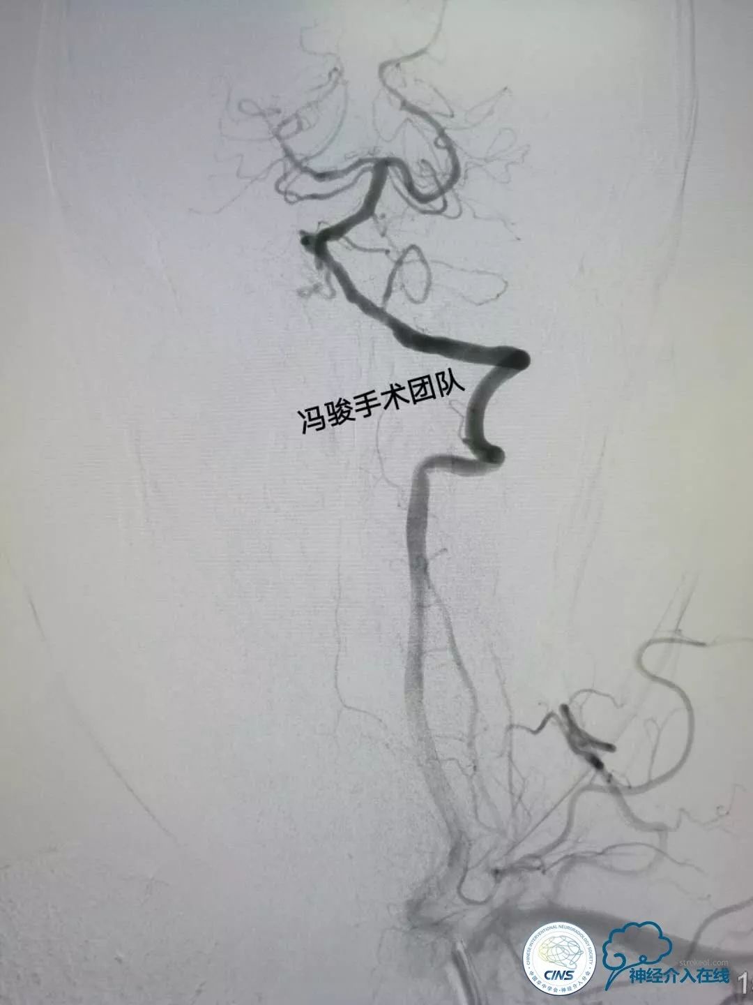 天新福—百家百言｜一例孤独椎动脉V4段并PICA重度狭窄支架手术及1年随访