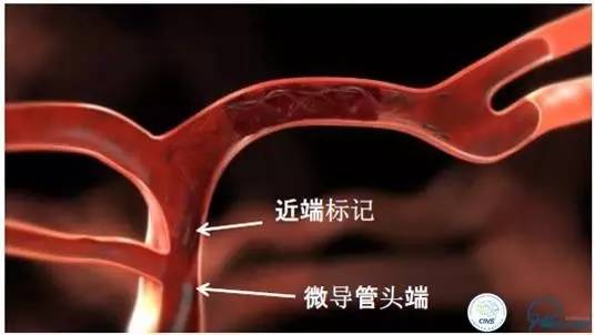 急性缺血性卒中静脉溶栓2018指南,急性缺血性卒中血管内再通标准