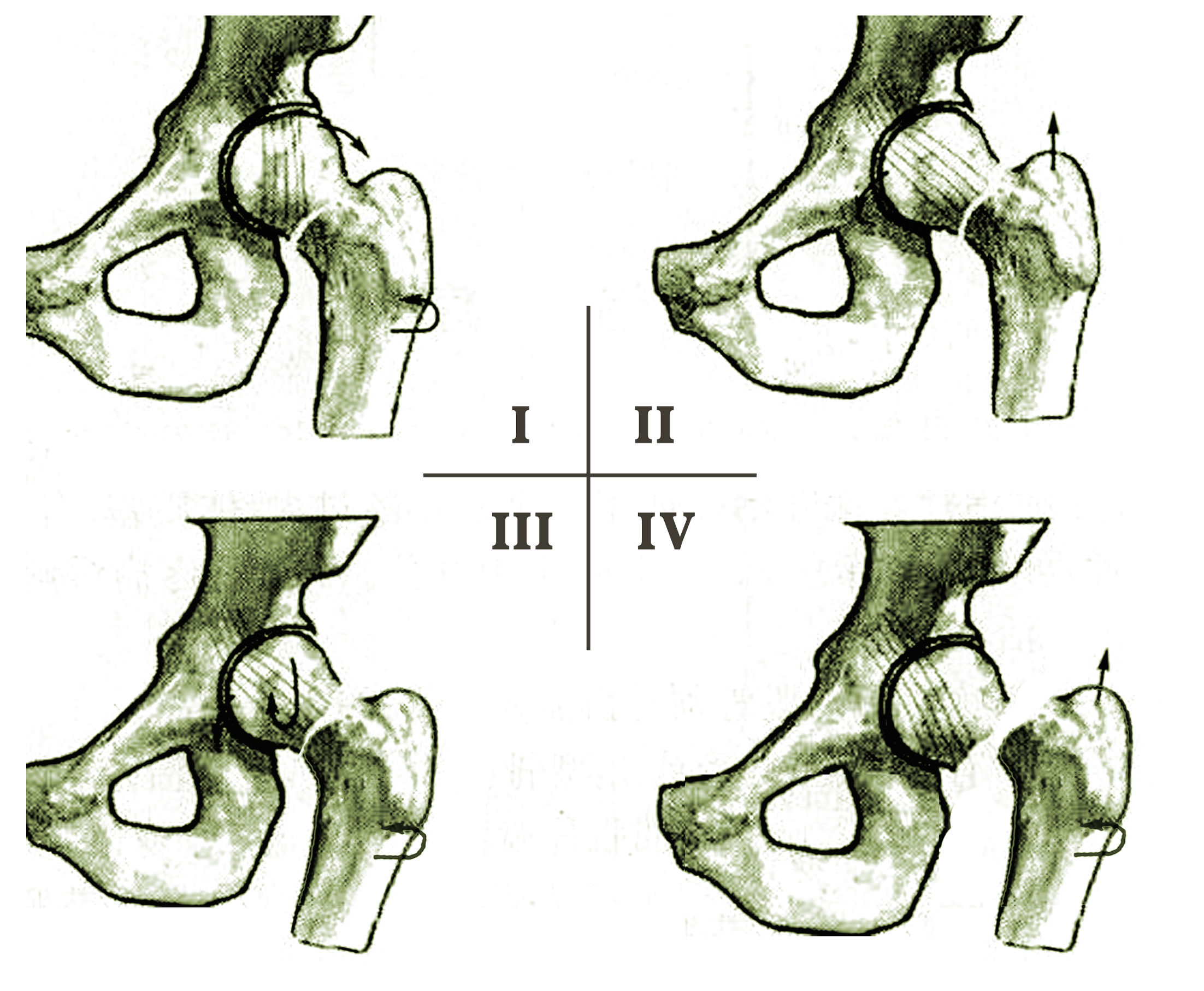 股骨颈骨折怎么才能恢复得快,股骨颈骨折一般多久可以下地负重