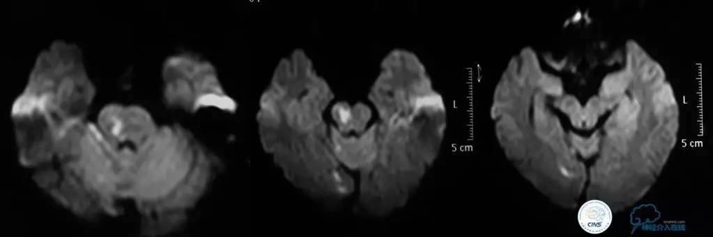 急性缺血性卒中静脉溶栓2018指南,急性缺血性卒中血管内再通标准