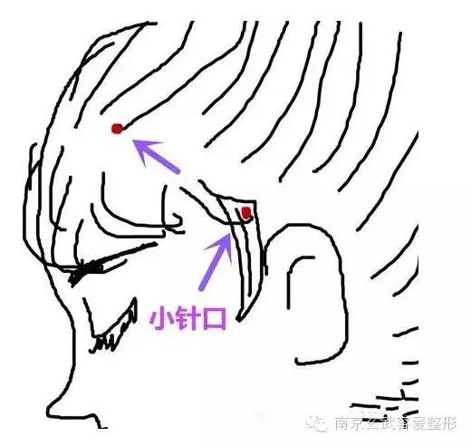 自体脂肪丰额头恢复期图,自体脂肪丰额头第一天图片