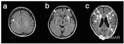 核磁共振轻度脑白质征象,脑白质内见多发斑点什么状况