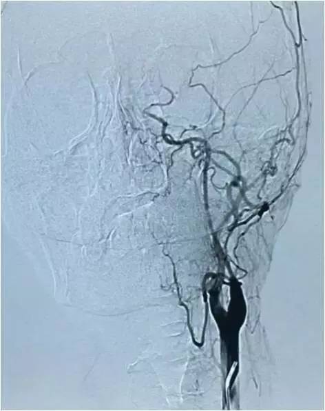 基底动脉顶端动脉瘤加左侧小脑上动脉瘤以Y型支架结合弹簧圈栓塞
