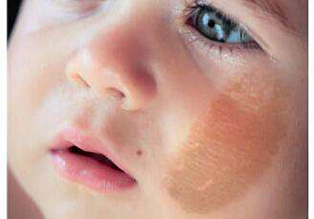 新生儿胎记种类与图片,新生儿胎记种类都有哪些