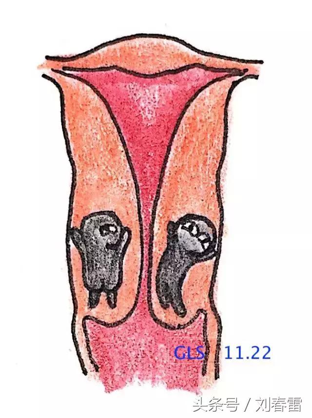 宫颈癌科普知识宣教视频,宫颈癌的科普知识宣传
