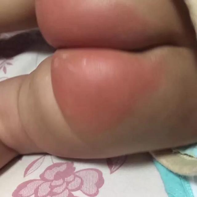 宝宝42天，屁屁有点破皮，有什么快速好起来的方法吗？