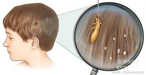 头上长虱子怎么办如何处理,头上长虱子的疤痕怎么消除