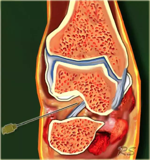超声引导下穿刺手法解析,超声介入穿刺和普通穿刺的区别
