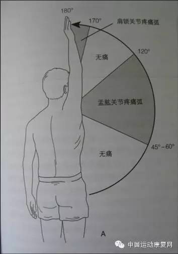 肩峰撞击综合征肩袖损伤怎么治疗,肩峰下撞击综合征导致肩袖损伤
