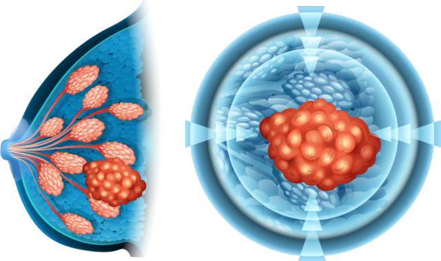 张斌医生谈乳腺癌生存率,专家讲解乳腺癌的分期