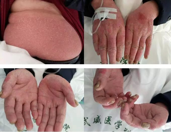 简单有效的银屑病偏方,中药泡浴治银屑病最好吗