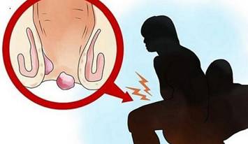 你有痔疮吗该怎么回答,你有痔疮