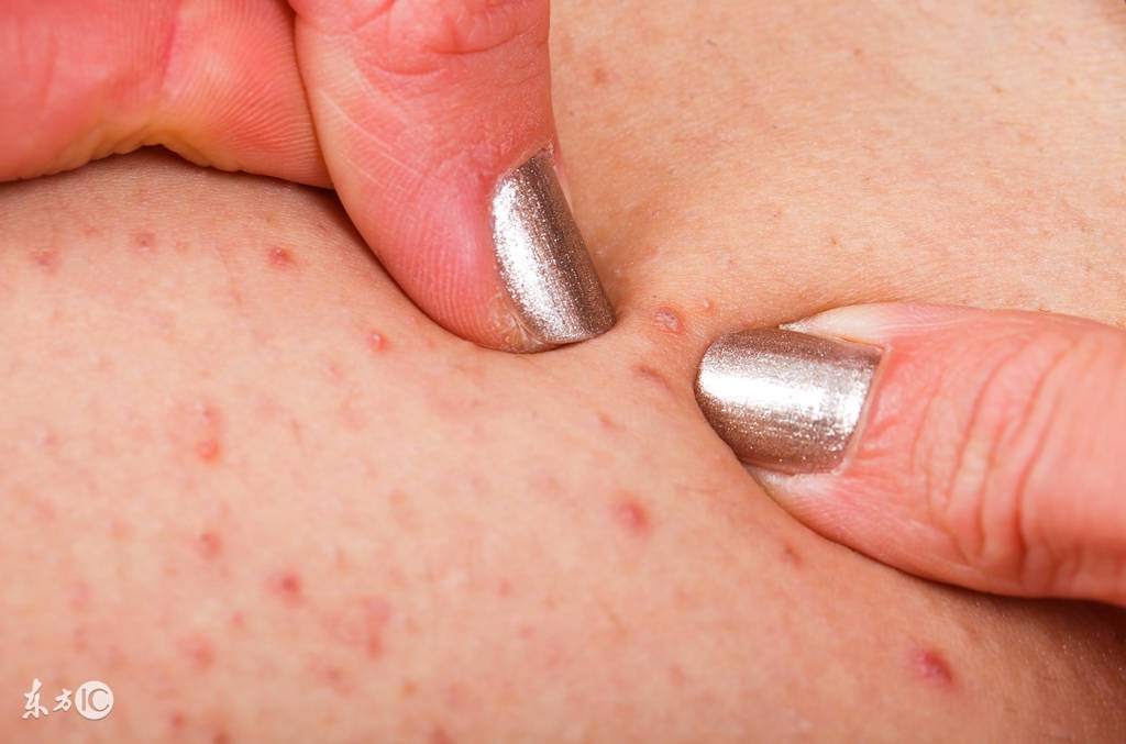 毛囊炎要怎么治疗才能彻底根除,如何防治毛囊炎