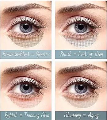 熊猫眼黑眼圈怎么护理,熊猫眼黑眼圈怎么消除改善睡眠