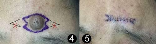 像小瘤一样的痣是什么,有个像疤一样的痣