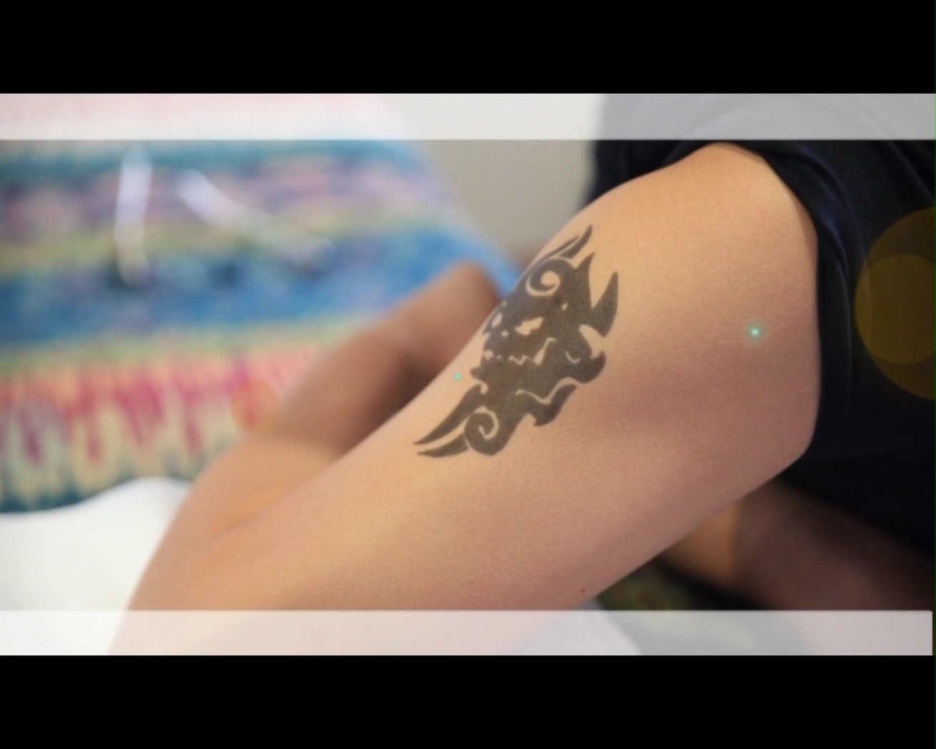 激光去除纹身的疤痕效果怎么样,激光祛除纹身有副作用