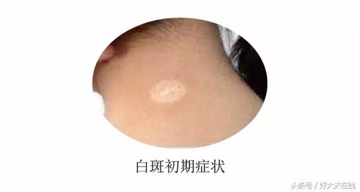 黑色胎记手术切除后还会癌变吗,孩子脸上有棕褐色胎记会癌变吗