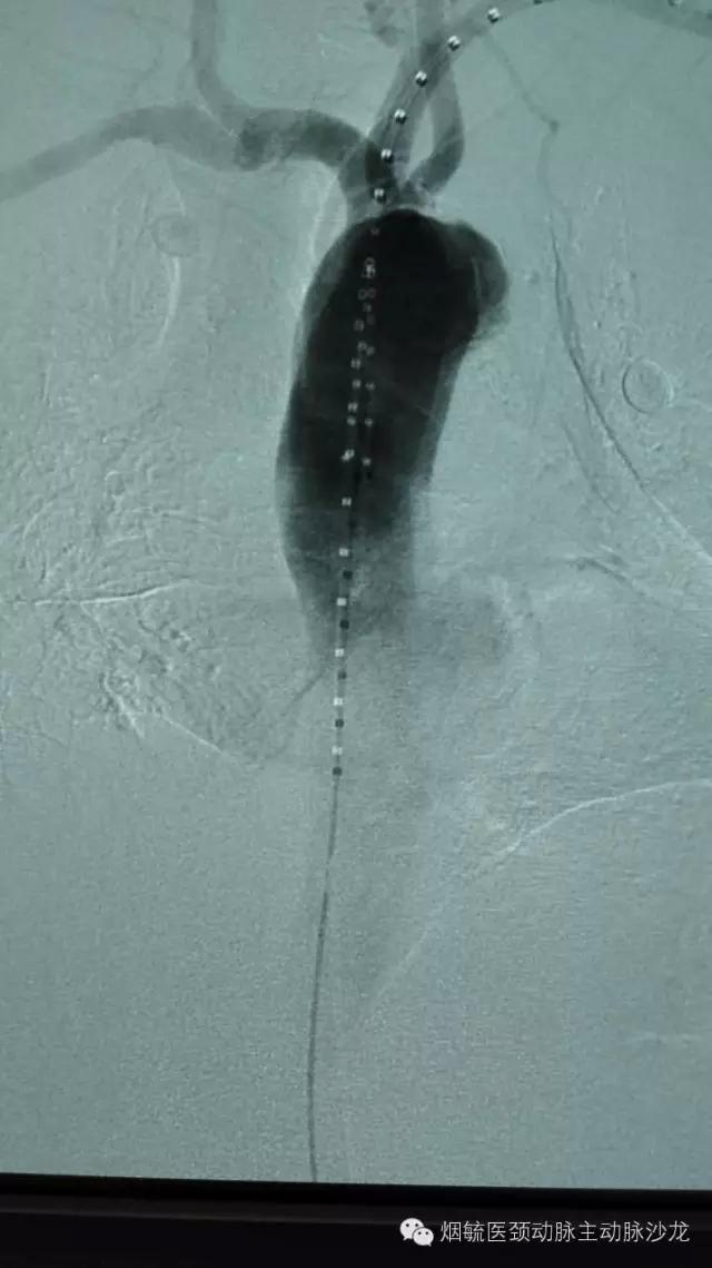 胃动脉溃疡,胃溃疡的溃疡点在主动脉