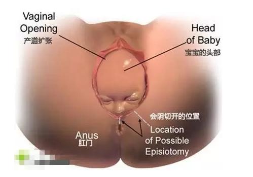 生孩子，你需要做会阴侧切么？