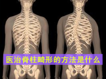 医治脊柱畸形常见方法都是什么