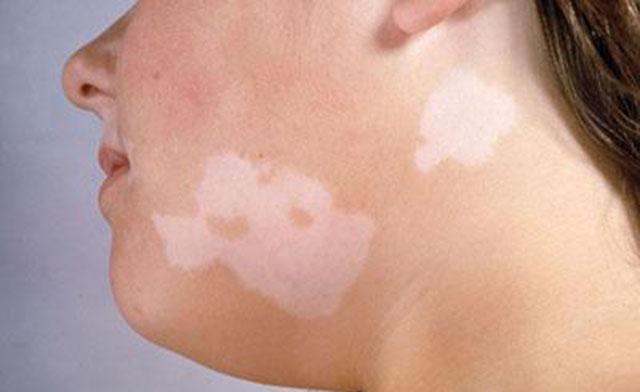 敷错面膜=毁容？美女敷“美白面膜”竟长出白斑！