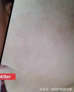 为什么一直反复长粉刺好了又长,脸上长粉刺如果什么都用会好吗