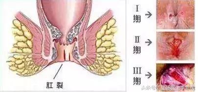 “菊花”痒怎么办？是忍还是挠？